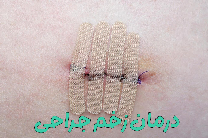 درمان زخم جراحی