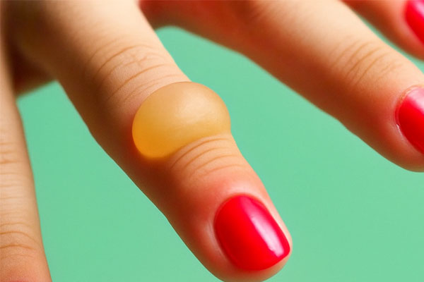 درمان سوختگی