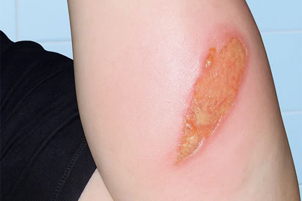 درمان زخم سوختگی