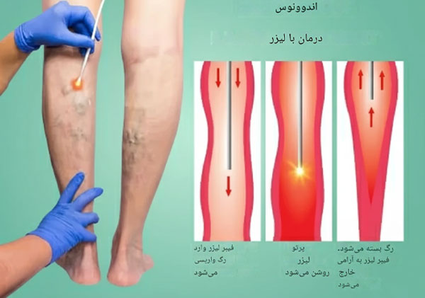 لیزر-واریس-پا