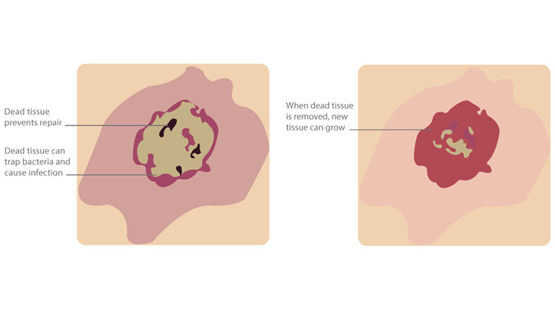 دبریدمان زخم دبریدمان زخم