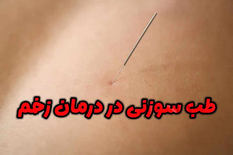 طب سوزنی در درمان زخم