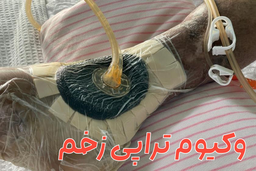 وکیوم تراپی زخم | درمان قطعی طبق پروتکل WHO 2025 + نتایج