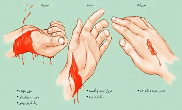 انواع-خونریزی