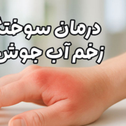 درمان سوختگی زخم آب جوش