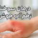 درمان سوختگی زخم آب جوش
