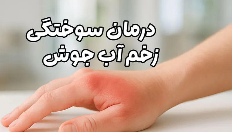 درمان سوختگی زخم آب جوش
