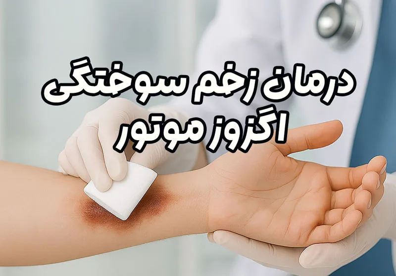 درمان زخم سوختگی اگزوز موتور
