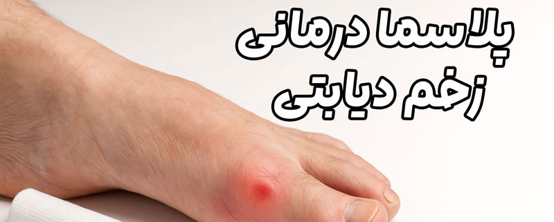پلاسما درمانی زخم دیابتی