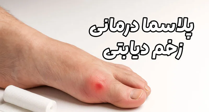 پلاسما درمانی زخم دیابتی