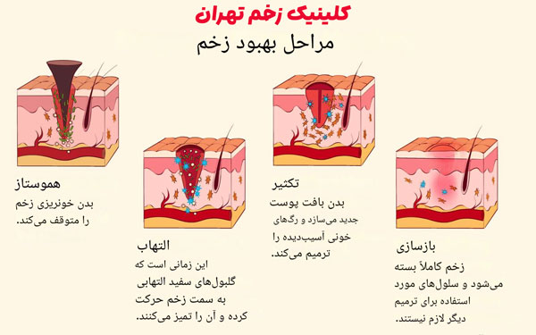 مراحل ترمیم زخم عمیق  مراحل ترمیم زخم عمیق
