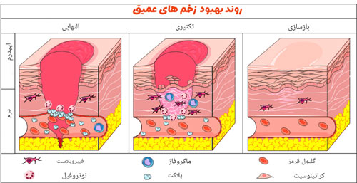 گام علمی در ترمیم کامل زخم های عمقی  گام علمی در ترمیم کامل زخم های عمقی
