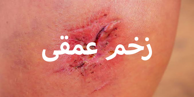 زخم های عمقی
