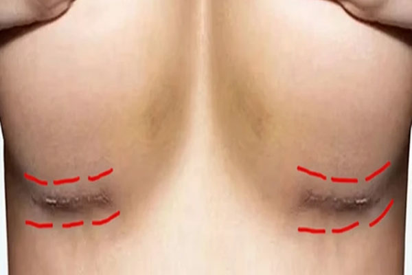 درمان زخم ماموپلاستی درمان زخم ماموپلاستی