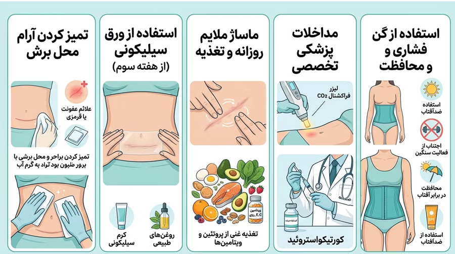 ابدومینوپلاستی