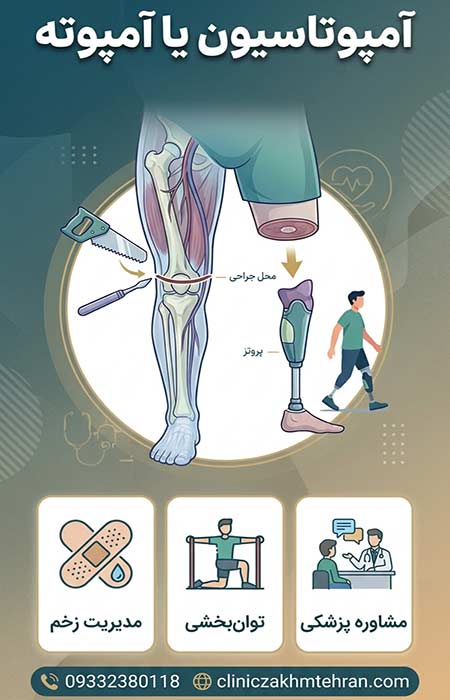 آمپوتاسیون-یا-آمپوته آمپوتاسیون یا آمپوته