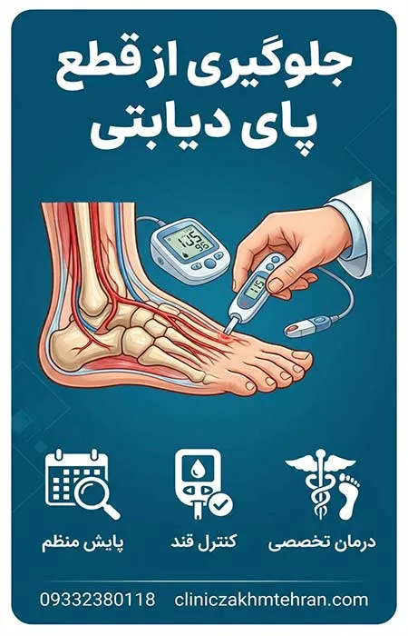 جلوگیری از قطع پای دیابتی